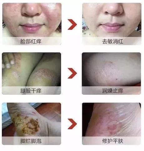 儿童鼻痒鼻塞鼻炎用什么喷剂,鼻腔缓解喷雾