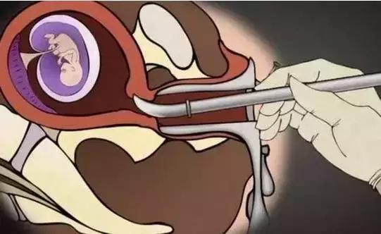 堕胎是杀人吗,堕胎就是杀生