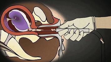 堕胎是杀人吗,堕胎就是杀生