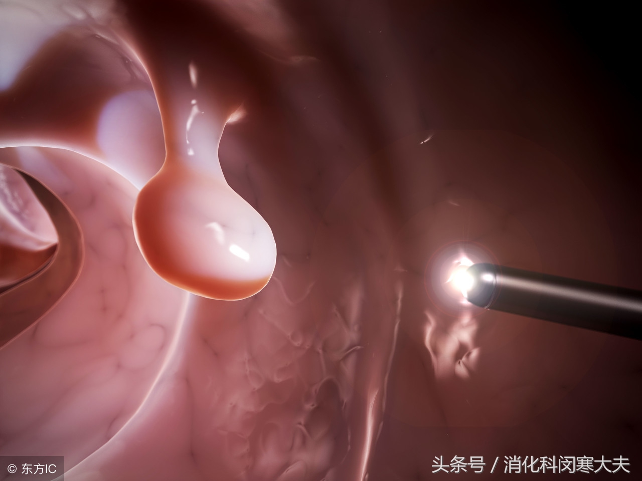 胃肠息肉切除后防止复发三大忌,肠息肉术后吃什么中药控制复发