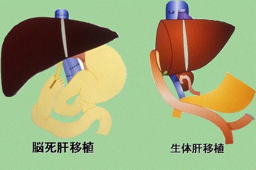 确诊肝硬化后来再检查就好了,医生能看出肝硬化吗