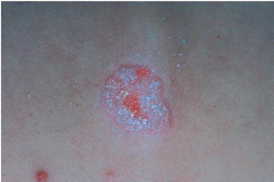 银屑病关节炎和银屑病区别,银屑病关节炎跟银屑病一样吗