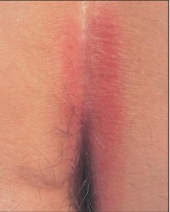 银屑病关节炎和银屑病区别,银屑病关节炎跟银屑病一样吗