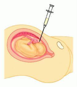 自然受孕怎样让胚胎着床发育好,高龄产子的成功案例