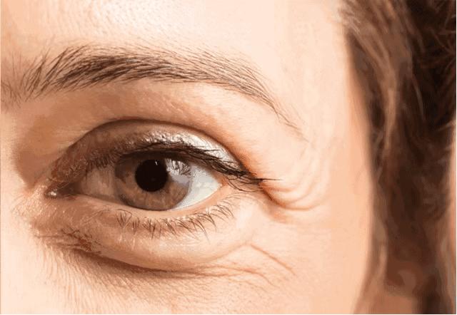 黑眼圈色素沉淀还有救吗,细纹黑眼圈用什么眼霜