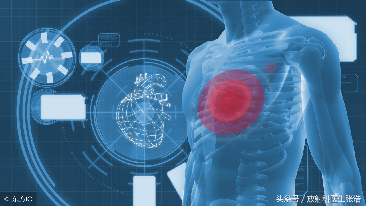 恶性胸腔积液诊断与治疗专家共识,有胸腔积液是结核性胸膜炎吗