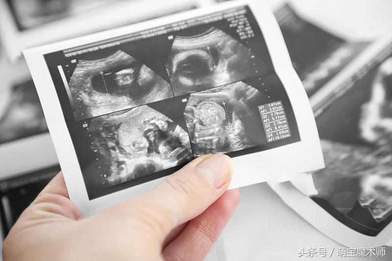 怎样更好做好胎心监护,孕早期如何自己使用胎心仪测胎心