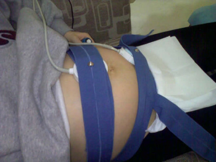 胎心监护图如何看胎儿有没有动,胎心监护图下面的线表示啥