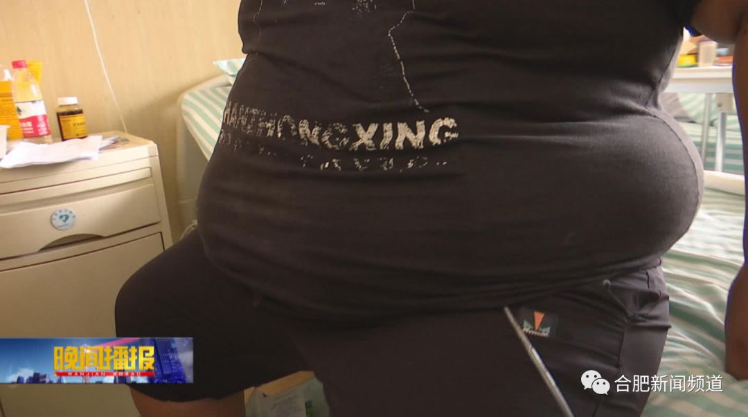 668斤山东第一胖减重手术,安徽第一胖减重