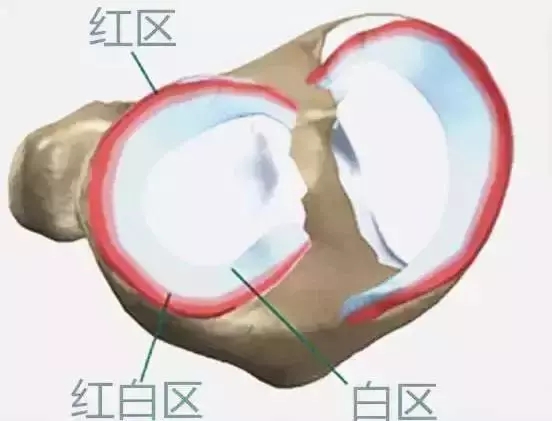 半月板治疗误区,半月板损伤一度的注意事项