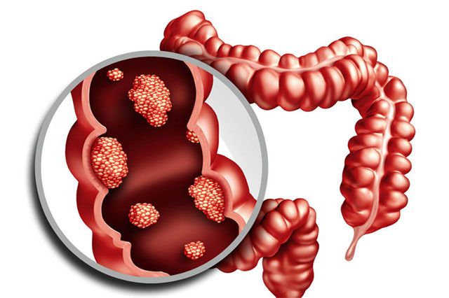 身上的小息肉可以割掉吗,身上到处长息肉怎么解决