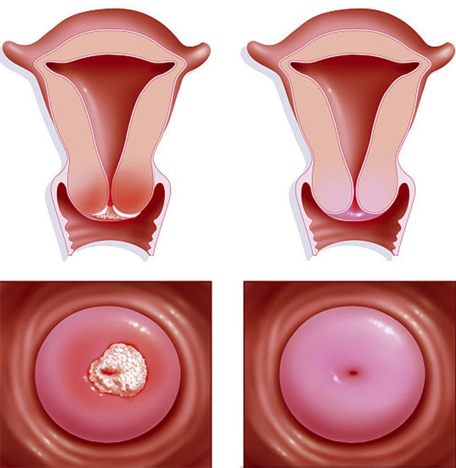 身上的小息肉可以割掉吗,身上到处长息肉怎么解决