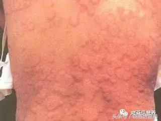 麻疹饮食,麻疹的饮食注意事项