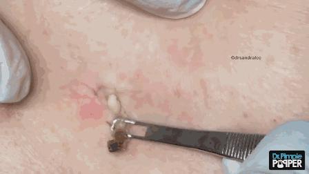 为啥那么多人爱看挤痘,为啥喜欢看挤痘痘