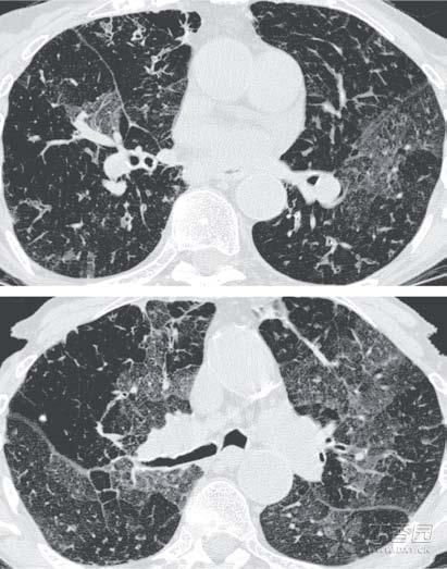 网红爆款竟然比香烟还毒7倍？加拿大竟还合法！最新研究：它会导致基因变异，引起肺癌！