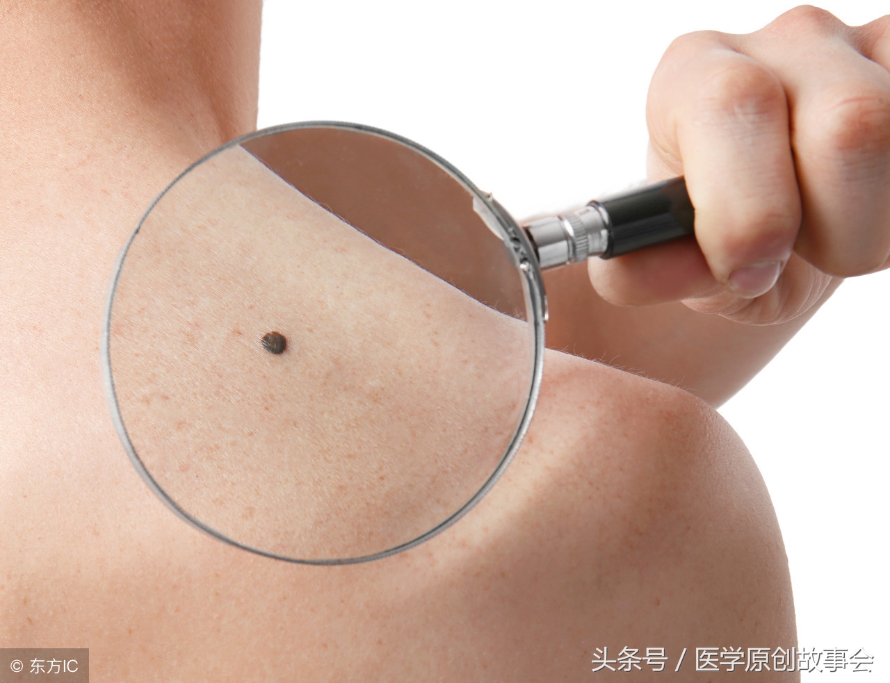 皮肤上长出这种痣的时候,十有八九是黑色素瘤,一定要及时切除