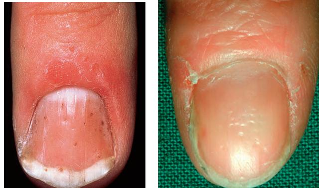 世界银屑病日银屑病关节炎,银屑病关节炎是银屑病后期吗