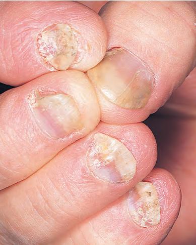 世界银屑病日银屑病关节炎,银屑病关节炎是银屑病后期吗