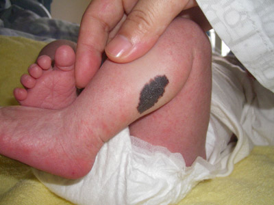 宝宝身上有大面积咖啡色胎记,宝宝胎记黑色斑块图片