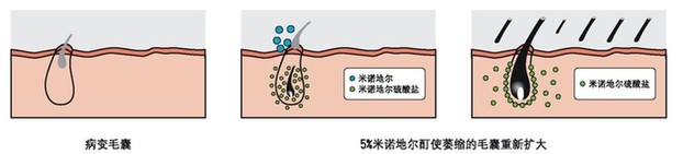 5个原因导致男人脱发,雄激素性脱发能治吗