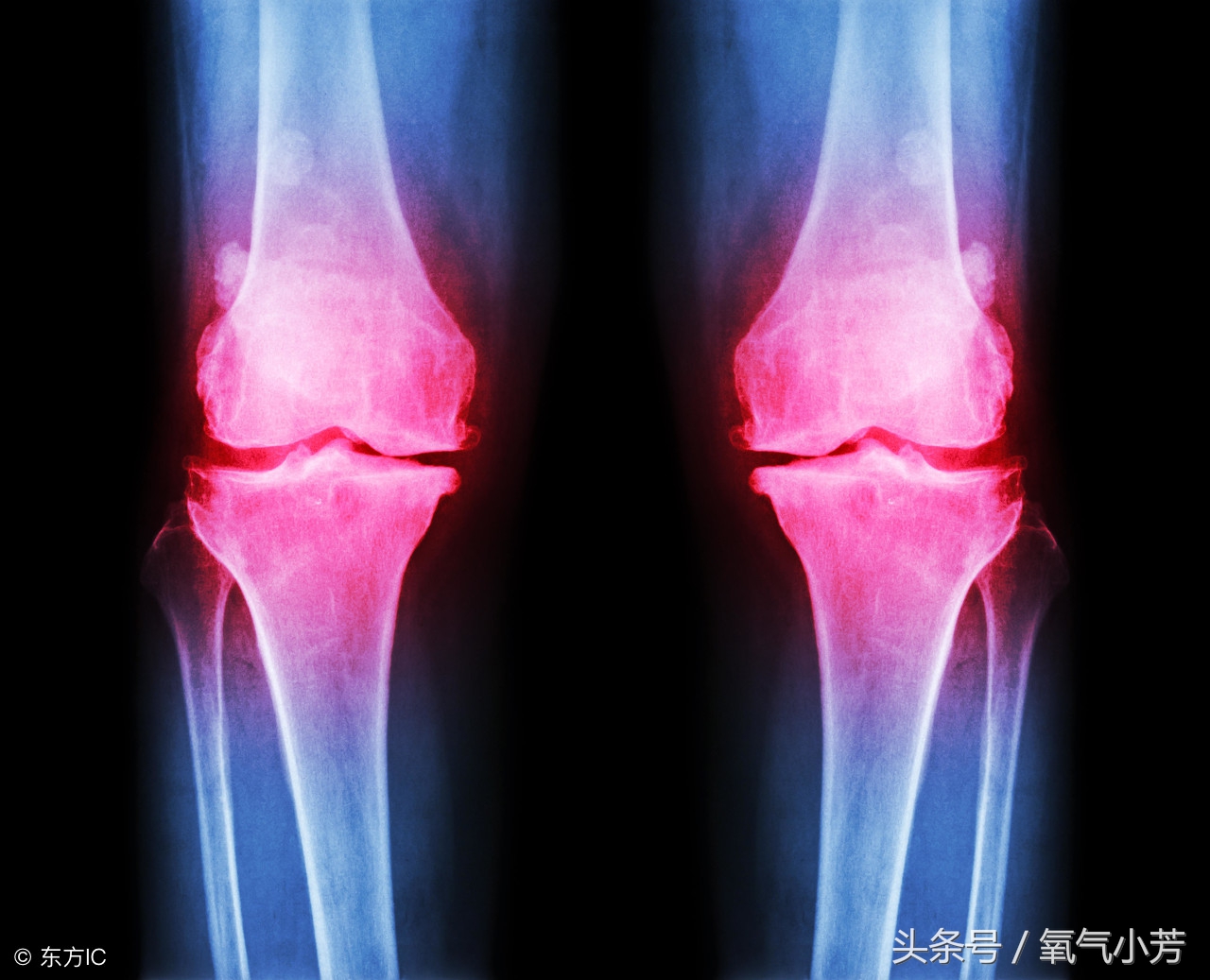 老年人的骨质增生吃什么药有效,骨质增生痛用什么药能缓解疼痛