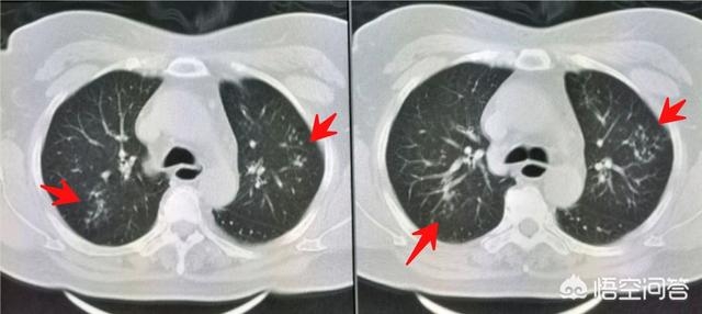慢性咽炎伴有食道反流该怎么治,慢性咽炎会容易高反吗