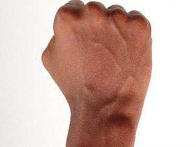 手背脚背青筋暴起是血管堵了吗,手背青筋凸起血管有个米粒小疙瘩