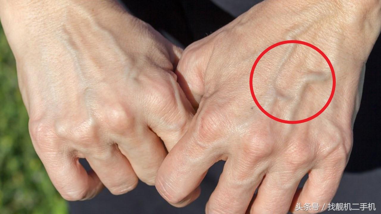 为什么人手上有青筋爆出来,50岁女人手上青筋暴起怎么回事