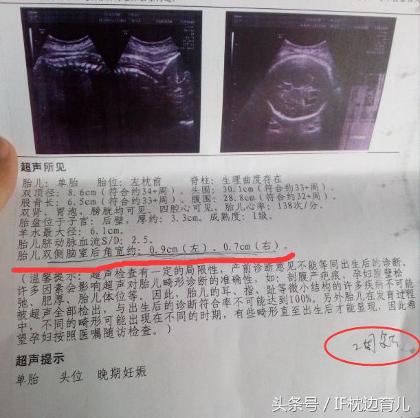 产检胎儿出现异常率有多少,产检报告结果显示唐氏低风险