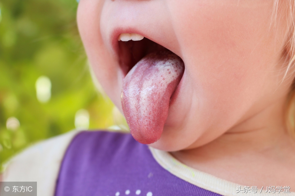 婴儿鹅口疮的症状及治疗方法,宝宝鹅口疮的症状识别及防治办法