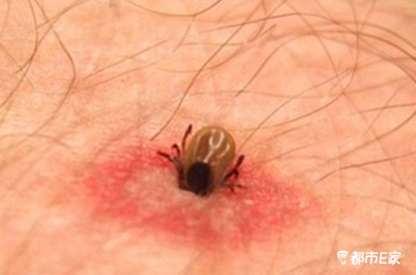 被马蜂蛰了怎么救治,男子被马蜂蜇伤146处伤