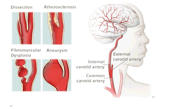 学术快报｜莫大鹏：颈动脉病变的复合手术治疗原则