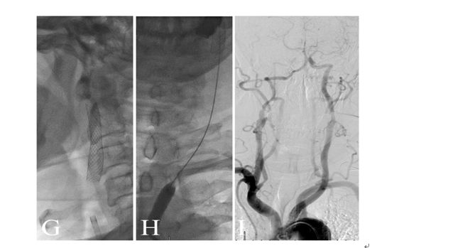 学术快报｜莫大鹏：颈动脉病变的复合手术治疗原则