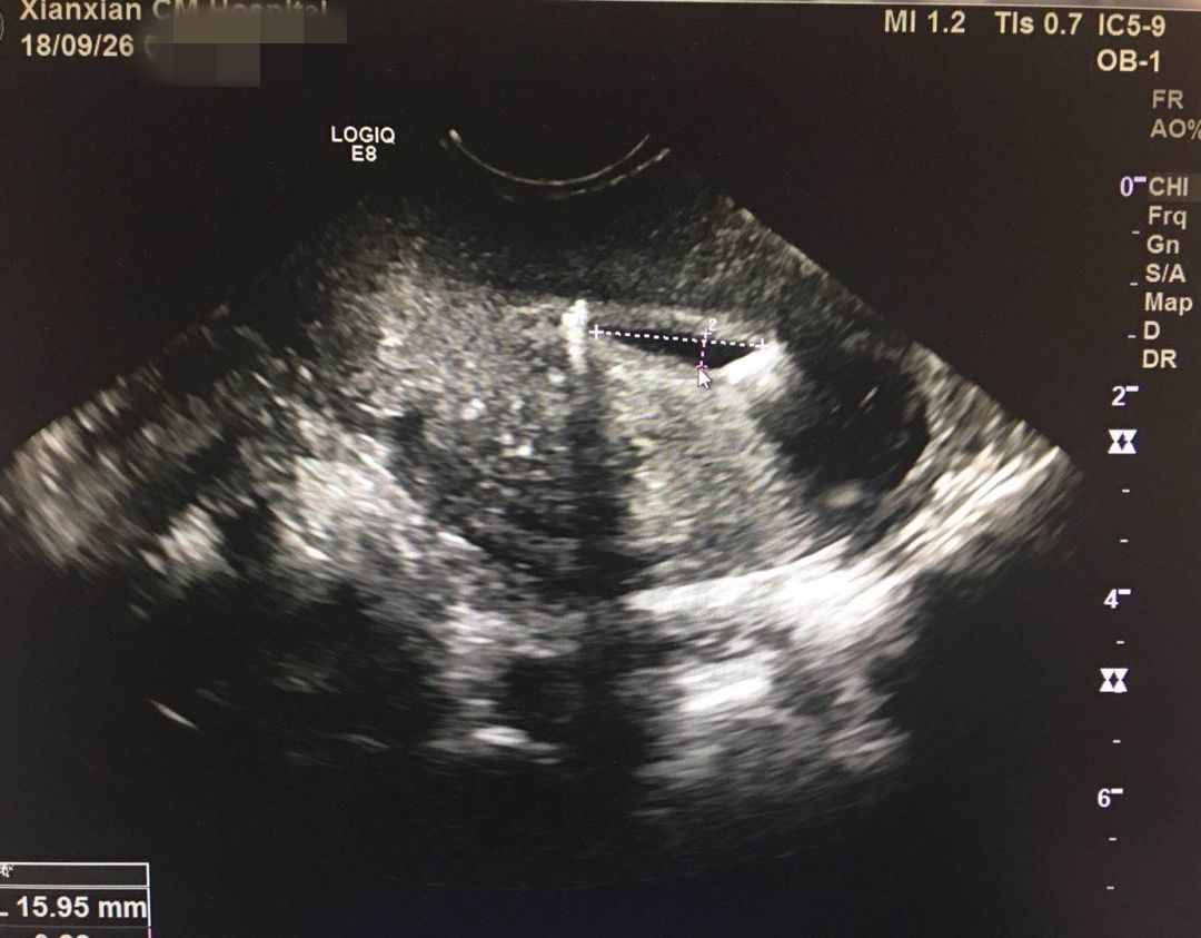 做b超憋尿膀胱痛,查膀胱做b超憋不住尿怎么办