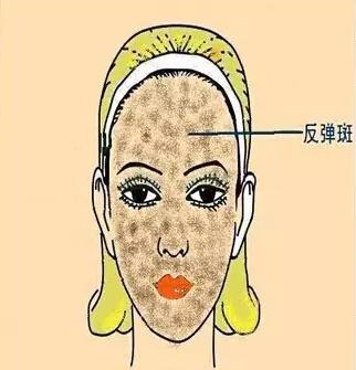 如何识别各种不同的斑,不同位置的色斑叫什么