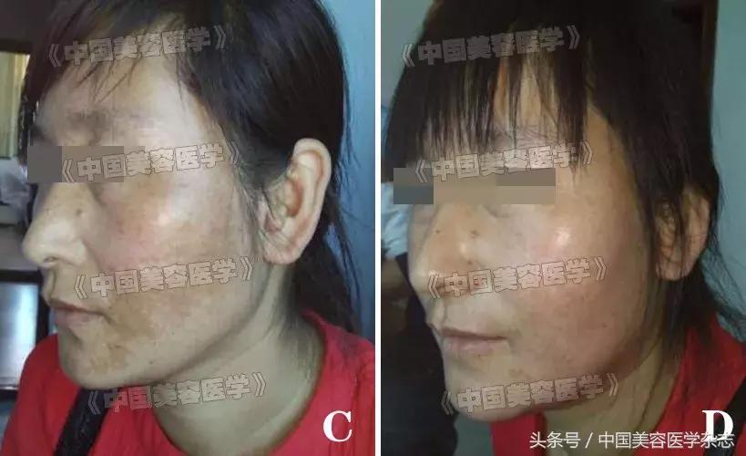 中药调理褐斑一般多久能见效,中药和针灸调理黄褐斑