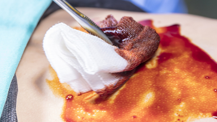 红药水对溃烂伤口愈合有用吗,红药水和紫药水哪个可以愈合伤口