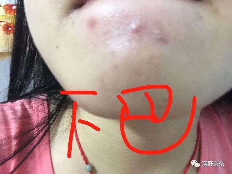 海绵微针后怎么护理,海绵微针第二天怎么护理