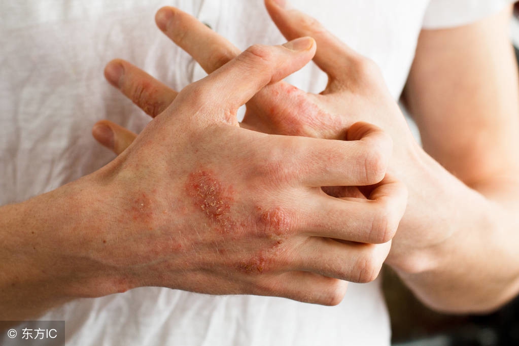 孕妇得了尖锐性湿疣怎么治疗最好,尖锐性湿疣的初期症状女性