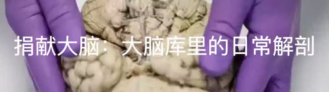 中国脑囊虫病,巨大脑囊虫病