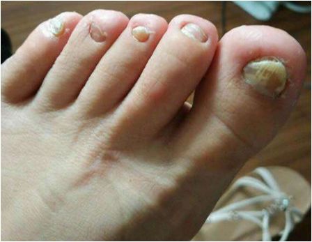 讨厌的灰指甲,还我美丽小脚丫!