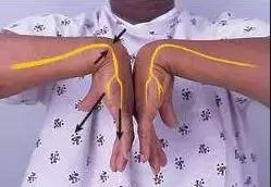 手麻、无力、肌肉萎缩？——你可能得了腕管综合征