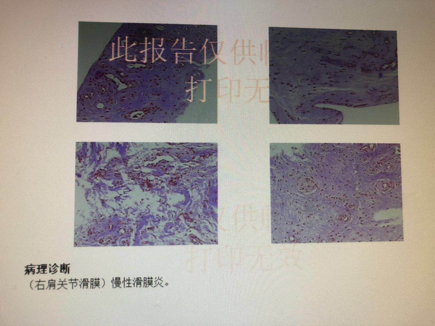 肩周炎手术松解后的锻炼方法图解,肩周炎手术治疗后怎么锻炼