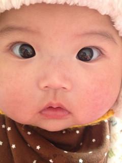 斗鸡眼如何预防和治疗,预防宝宝斜视斗鸡眼