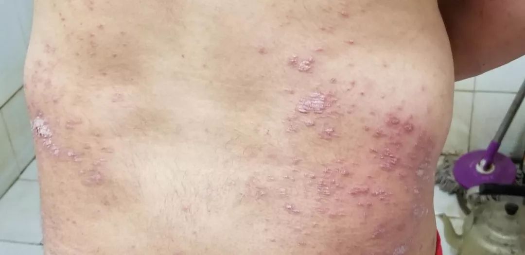 娴欐睙鐪佷腑鍖绘不鐤楅摱灞戠梾,鍏勫紵淇╅兘寰楃櫧鐧滈