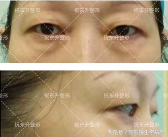 做眼袋提眉手术能变得年轻吗,哪种人不适合做提眉去眼袋