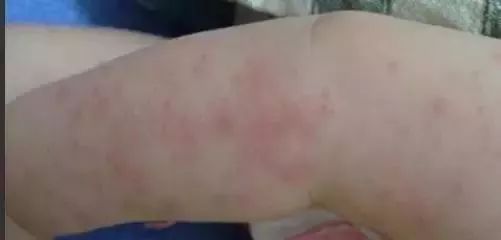 痒痒的皮肤怎么治疗,秋季皮肤过敏泛红发痒小妙招