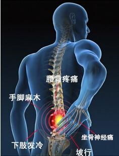 腰椎4.5突出压迫坐骨神经疼怎么办,腰椎间盘突出症神经治疗