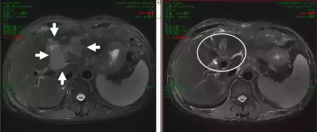 放疗疗效,放疗效果如何体现