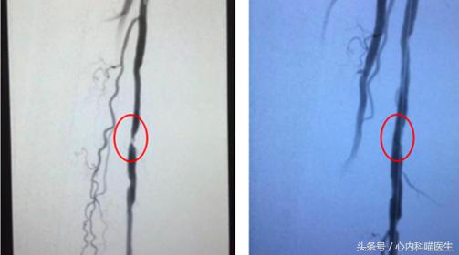 长期药物治疗可以减轻冠状动脉狭窄、减少心绞痛和心梗发生